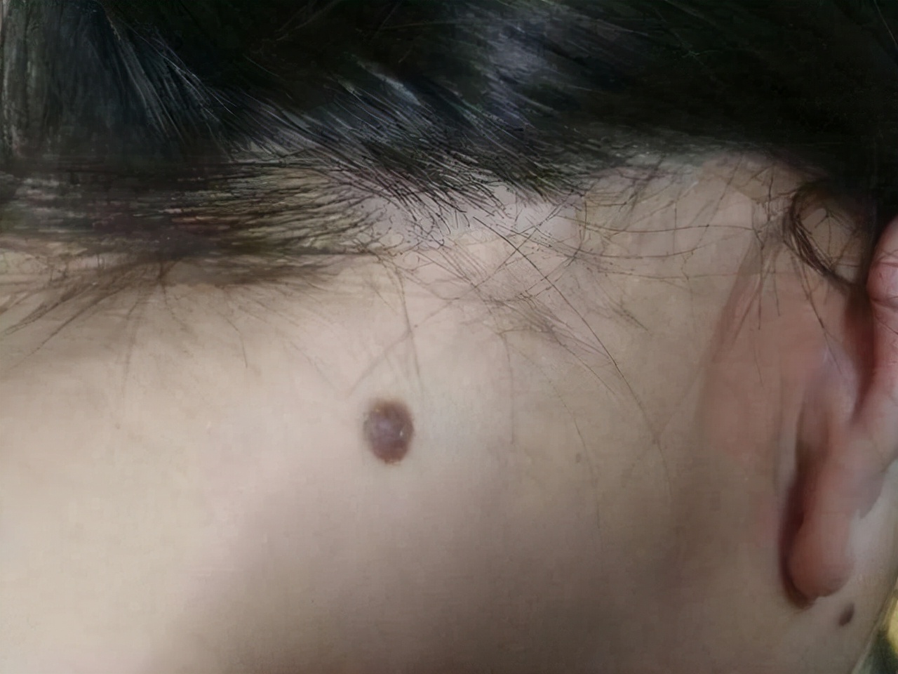 怎么在医院确定黑痣是不是良性的,黑痣隆起挂什么科检查