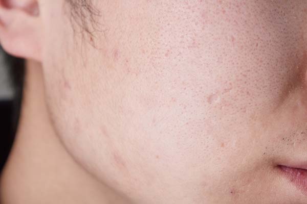 雄性激素过高有什么危害,雄性激素越高是不是长得越丑