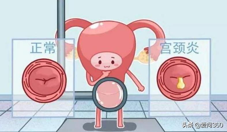 日常出现这些问题可能是宫颈炎,不要大意,做好预防措施