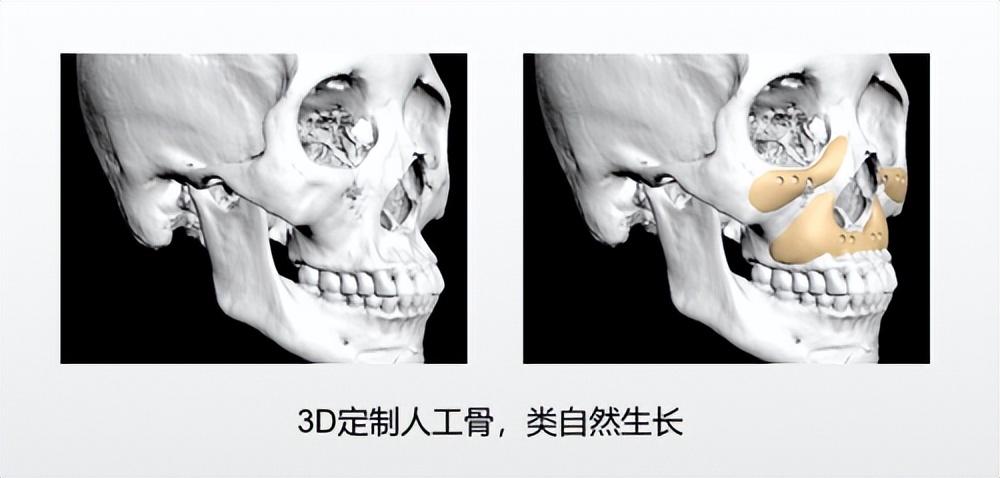 重庆华美整形美容医院假体下巴,重庆华美下颌角整形案例