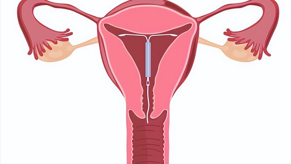 女性取出节育环后多久可以怀孕,节育环在体内有年限吗