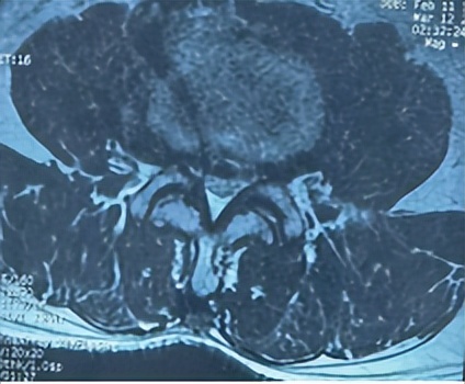 门医技术|门头沟区医院骨二科成功应用微创椎间孔镜技术治疗两例腰椎管多节段狭窄症