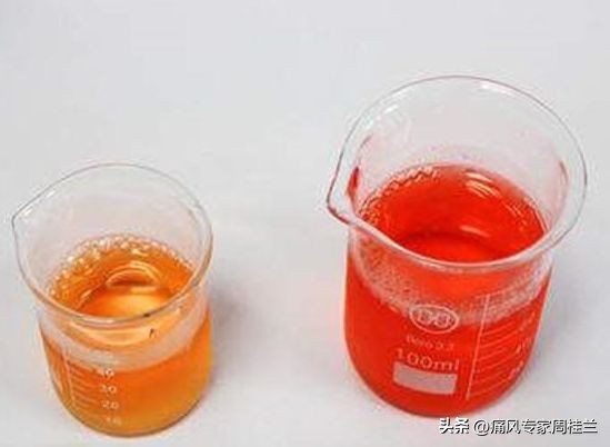 尿酸高的七个征兆官方,尿酸高都有什么前期征兆