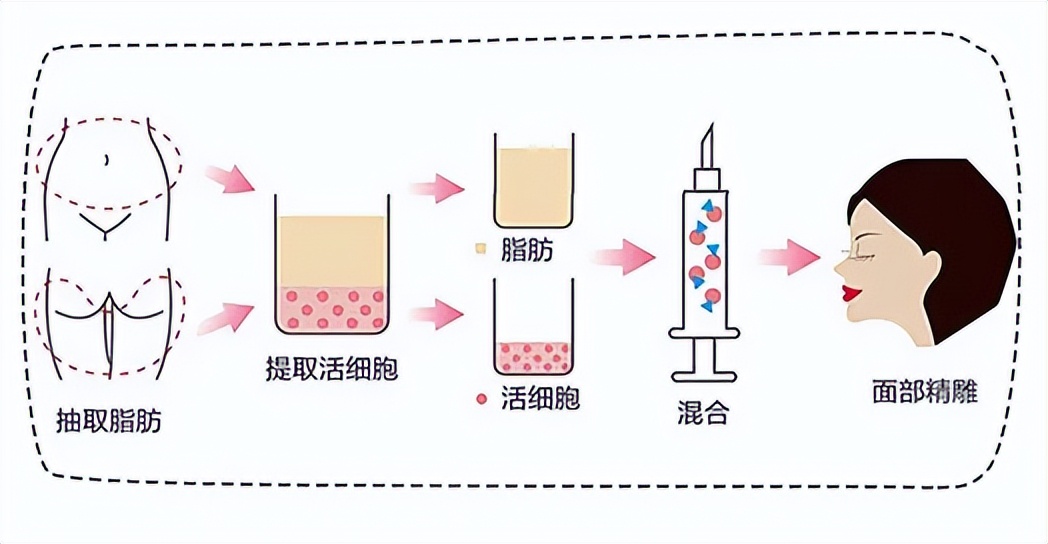 面部填充失败案例,脂肪填充面部失败案例
