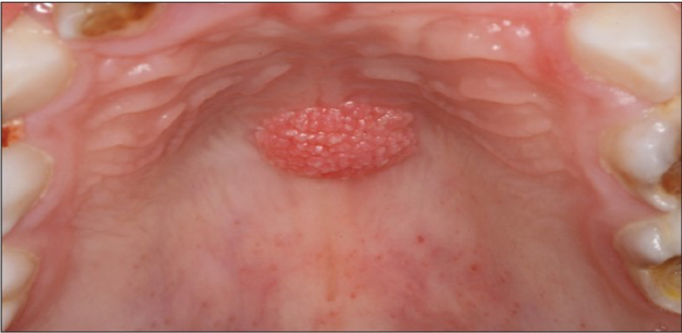 为什么2岁男童也会感染人类乳头瘤病毒？