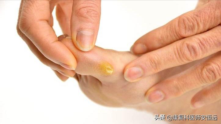 脚底板前面长茧子很疼怎么治疗,脚底板长很厚茧子疼怎么去除