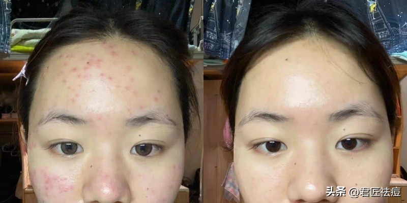 女孩眉头起痘痘的原因及祛痘方法,额头长痘的原因及祛痘方法