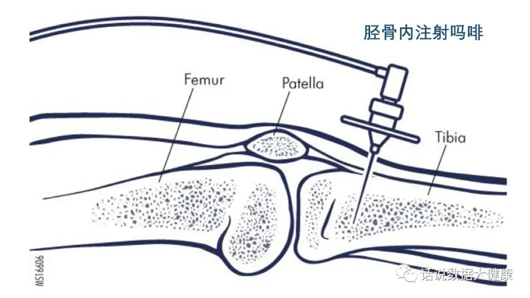 疼痛非药物治疗,疼痛无需再忍受