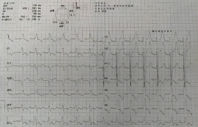 心衰患者icd植入后会加重心衰吗,43岁心衰患者植入人工心脏