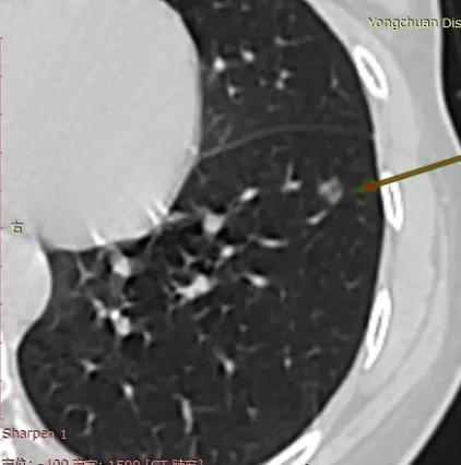肾癌切除后七年发现软组织结节,肾癌切除后发现结节