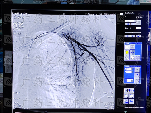 彭齐荣广医三院,广州彭齐荣医生
