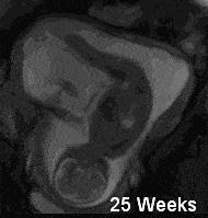 孕25周的胎儿是什么样的,怀孕25周胎宝宝是头位还是臀位