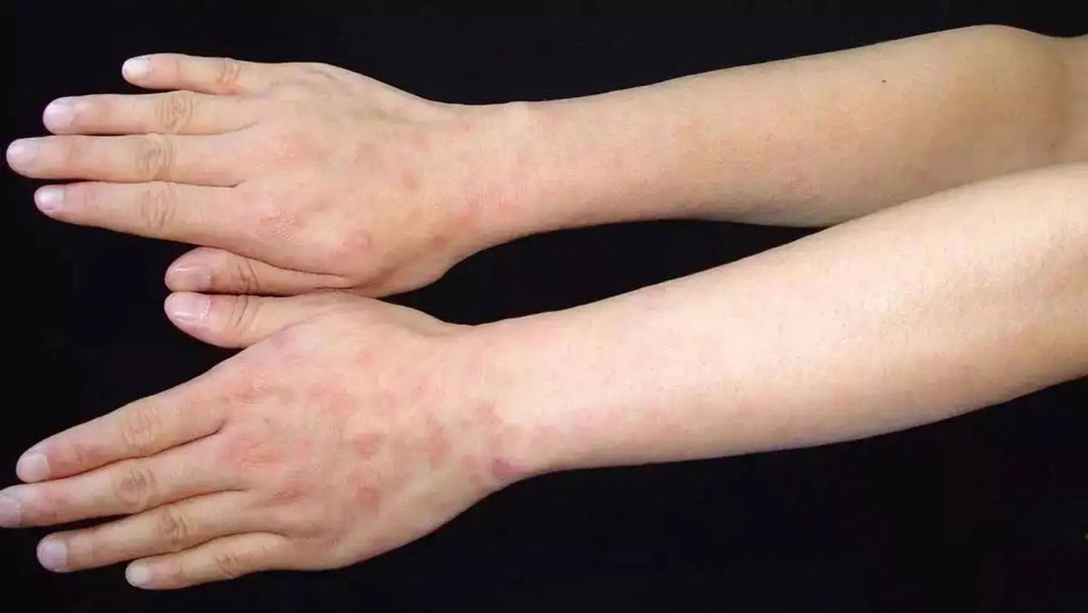 水银为什么能治疗梅毒,中世纪水银治疗梅毒