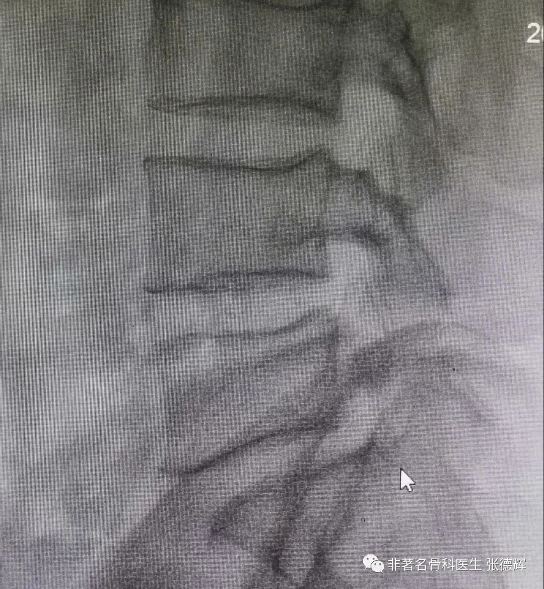腰椎峡部裂的最好治疗方法,腰椎峡部裂