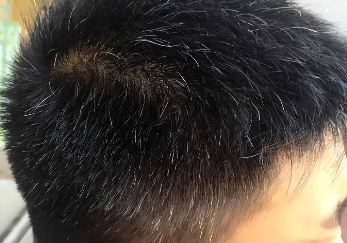 白头发什么原因产生的怎么治疗,白头发是从根部开始白是什么原因