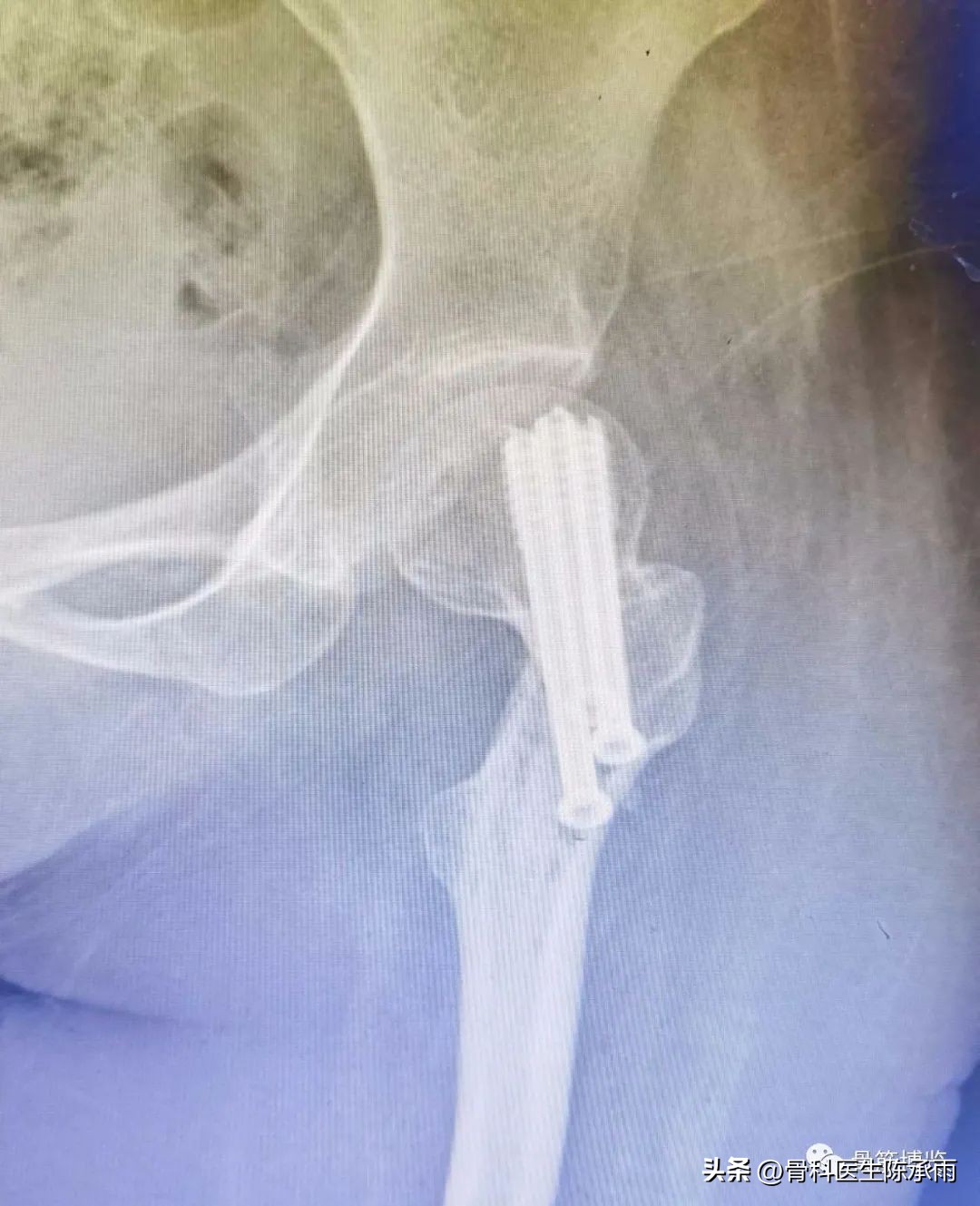 股骨颈闭合复位内固定术后护理,股骨颈骨折闭合复位的技巧