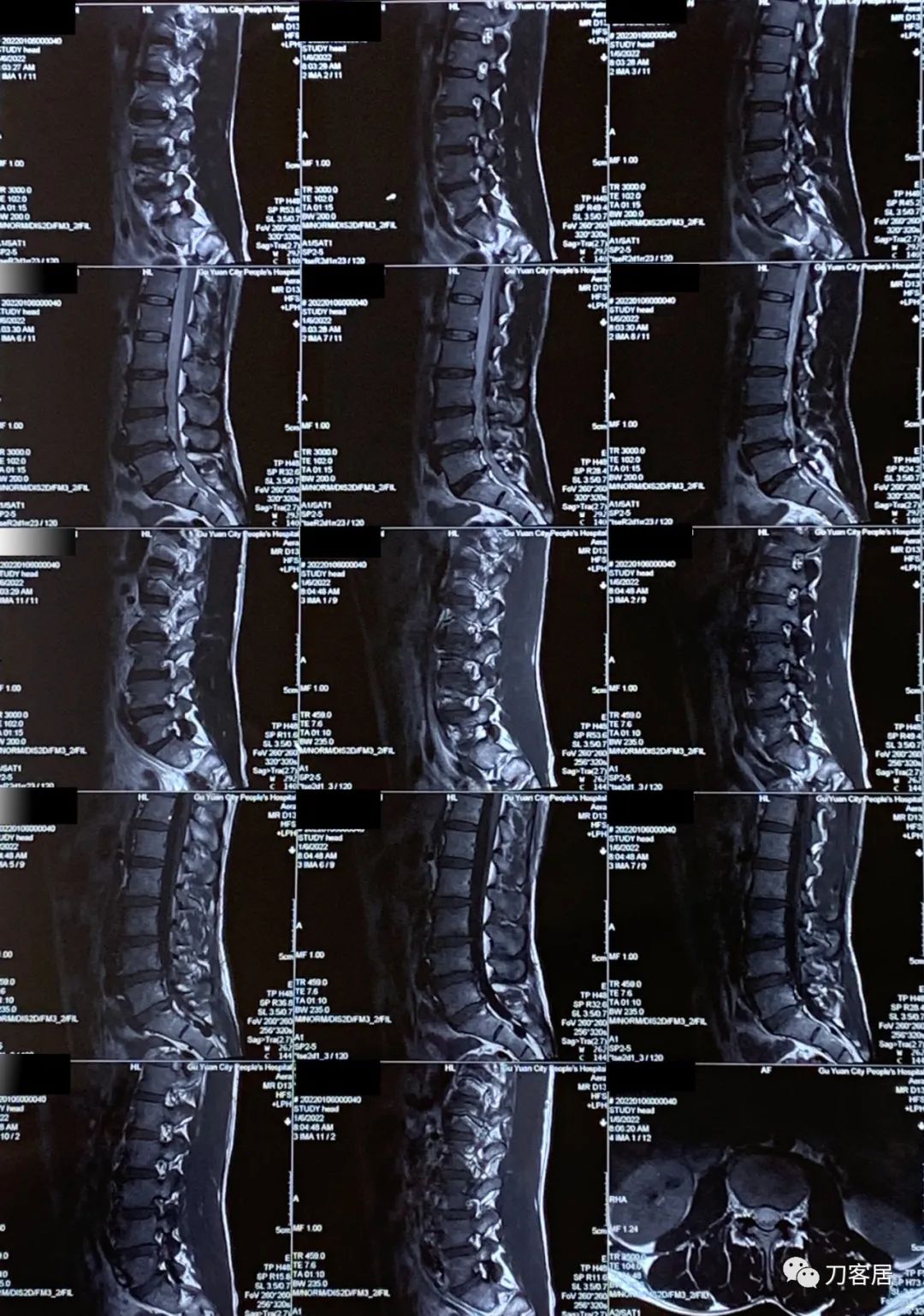 腰椎间盘突出压迫腿疼看神经内科,腰椎间盘突出看骨科还是神经内科