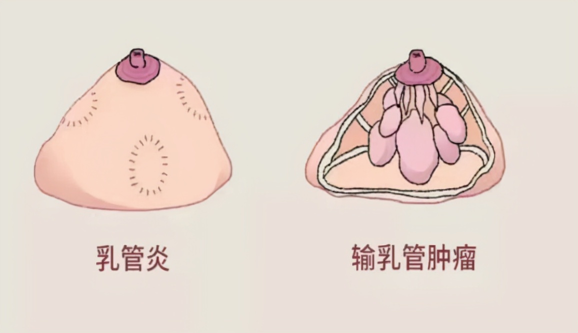 乳腺溢液最简单是什么病,乳腺溢液怎么才能知道是良性的