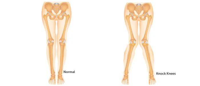 拉筋板真的会瘦肌肉小腿么,拉筋板真的可以瘦哪里