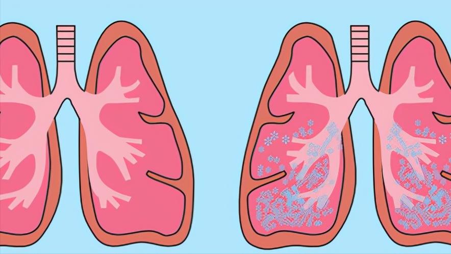 心脏瓣膜病手术具体怎么做,心脏瓣膜病什么程度需要手术