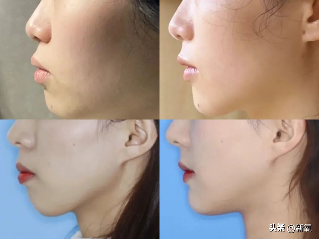 牙齿正畸和骨骼正畸的区别,牙齿正畸和眼轴增长有关系吗