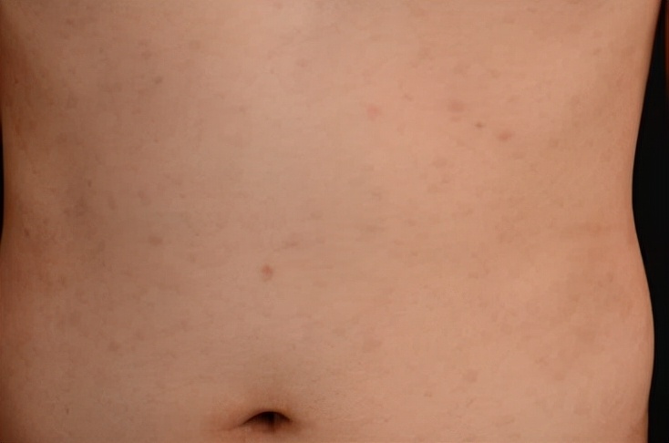 一级梅毒患者治疗后注意事项,和梅毒患者治疗期间接触