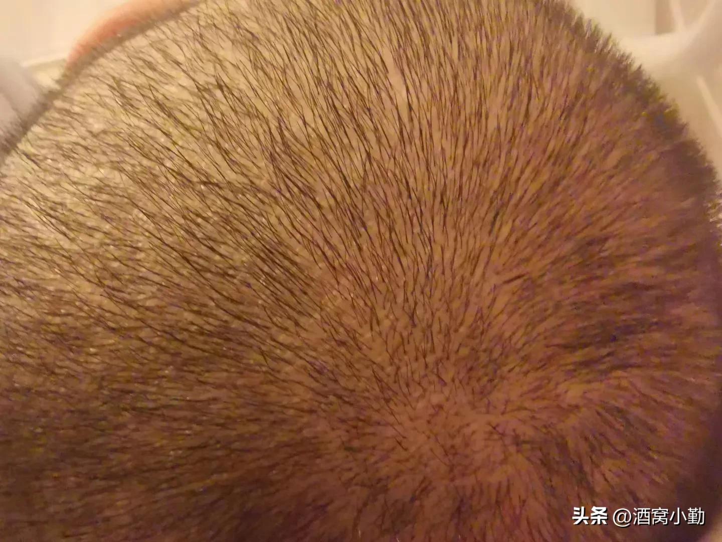 因祸得福。我因皮肤过敏去看医生，居然同时改善了皮肤及睡眠问题