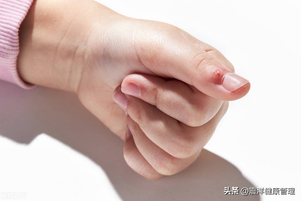 通过性传播疾病都有哪些,通过性传播的疾病有什么症状