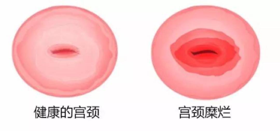 宫颈糜烂和生活作风有关吗,宫颈糜烂是不注意卫生得的吗