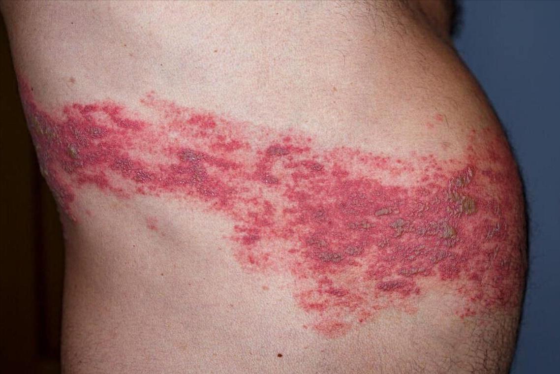 新冠带状疱疹症状和表现,新冠后带状疱疹发病率