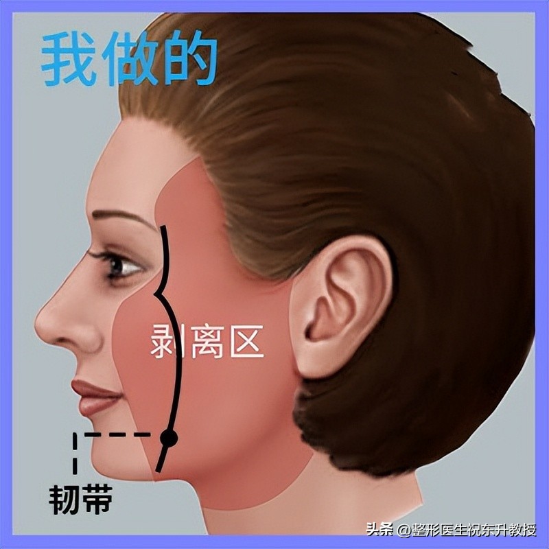 拉皮改善法令纹手术的危害有哪些,脸部法令纹做手术怎么去除