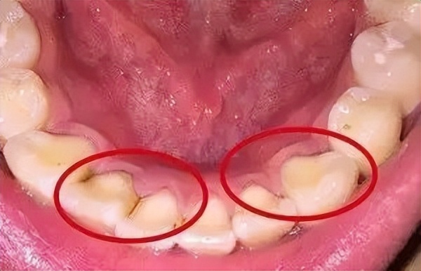 8岁孩子牙齿黑黑的怎么办,牙齿上有黑点儿怎么办