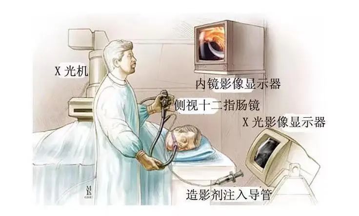 ercp手术后胆管发炎,化脓性胆管炎指南