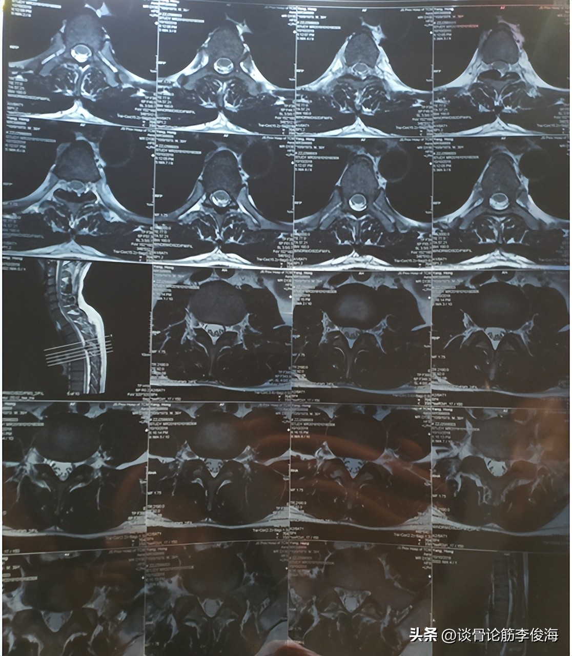 关于椎间盘突出的康复治疗,椎间盘突出治疗指南