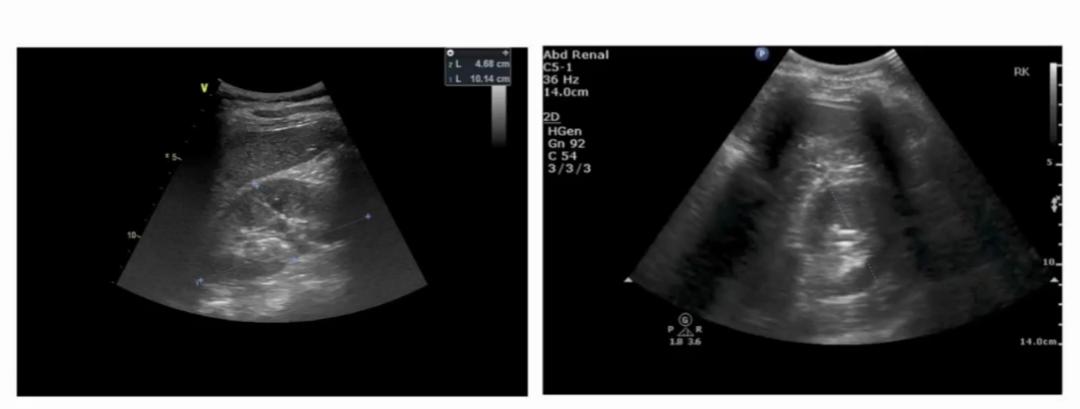 「肾脏病学」刘丽霞教授：肾脏血流动力学监测实施路径