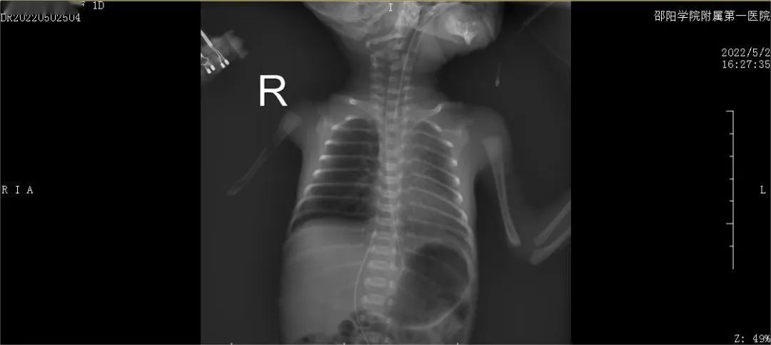 极低出生体重儿抢救新闻,一例极低体重早产儿的个案护理
