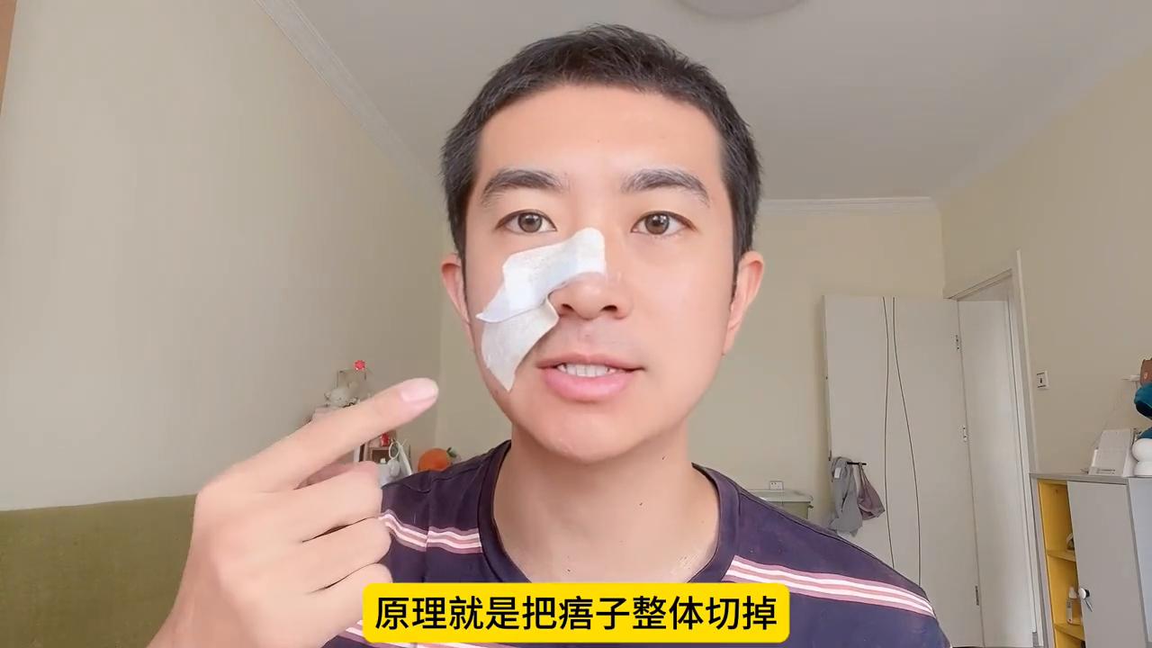 在脸上祛痣打麻药痛吗,脸上祛痣激光还是液氮