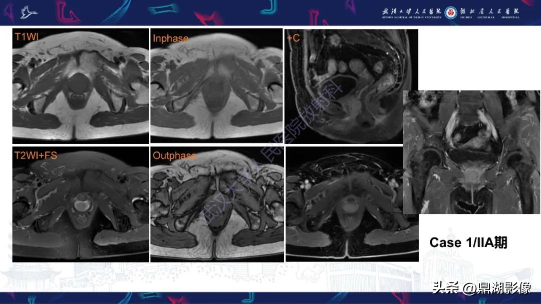 阴道肉瘤的早期症状,阴道里长肉瘤是啥症状