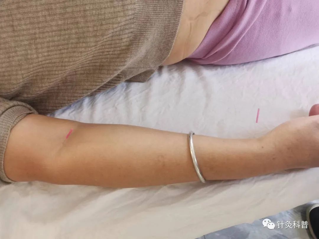 喉咙热有烧灼感针灸,舌头有烧灼感针灸方法