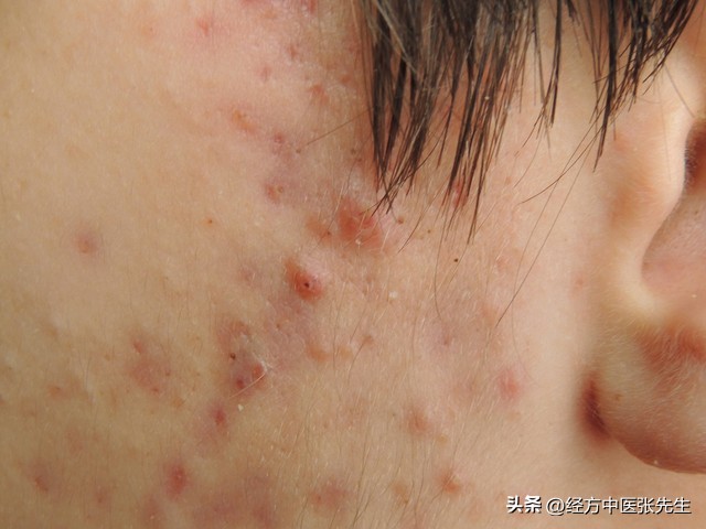 红斑丘疹擦什么中药,头皮疹用什么特效药