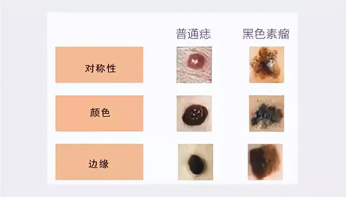 你是否众“痣”成城？跟我一起专心致“痣”