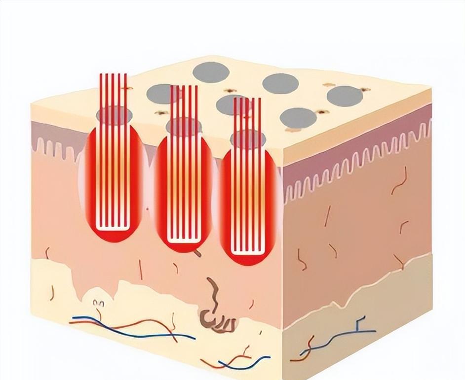 激光后化脓怎么处理,尖锐性湿疣激光手术后化脓