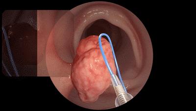 息肉一定会癌症吗,增生息肉切完会癌变吗