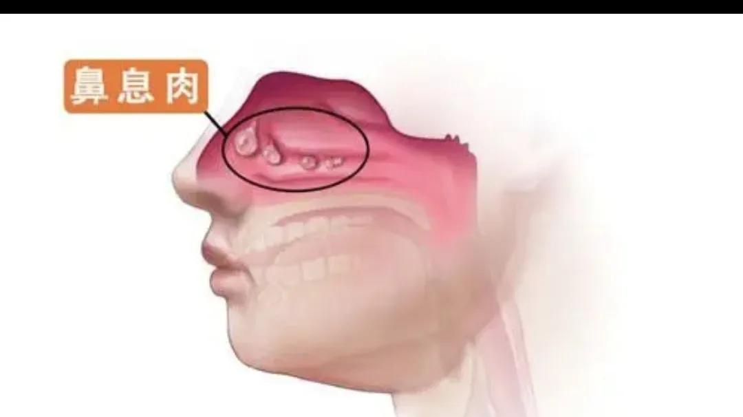 体检报告出现“息肉”，5种常见息肉哪些是良性，哪些会癌变？