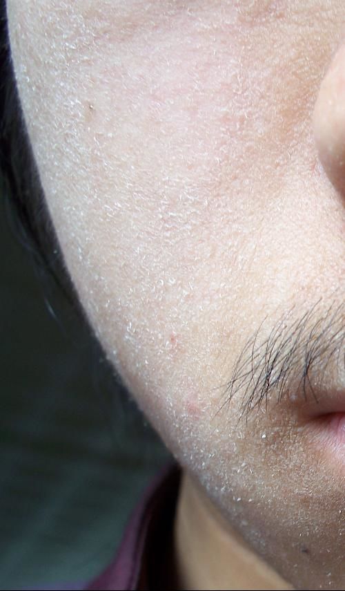 脸上起皮了是怎么回事,脸上起皮是什么原因怎么办