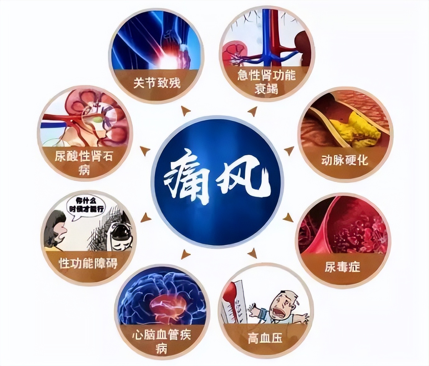 为什么尿酸值正常痛风还会发作,尿酸降到正常值为什么还经常痛风