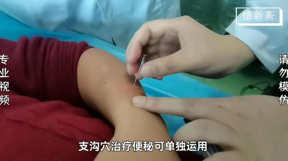 针刺支沟穴照海穴,支沟穴针灸治疗便秘视频