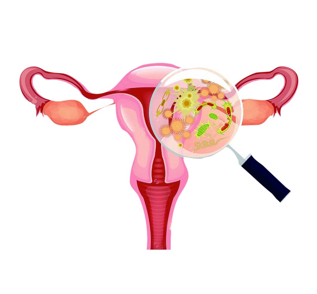 导致子宫内膜异位症患者不孕,造成不孕不育的隐形杀手