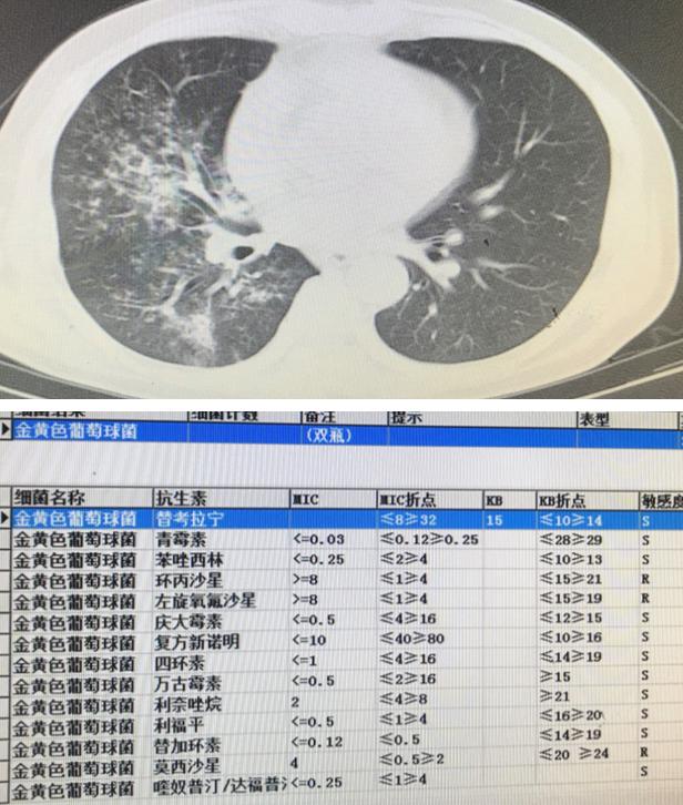 免疫缺陷病会并发什么病,什么是免疫缺陷肺部感染