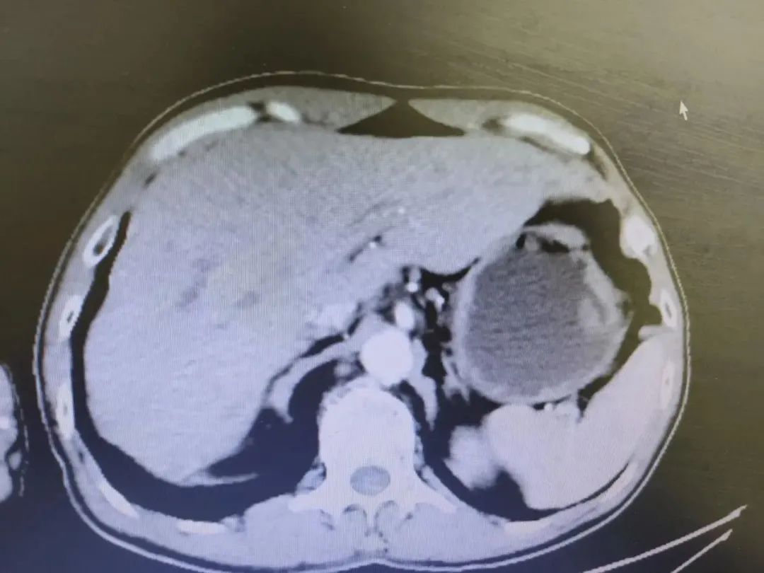 胃癌晚期化疗的全过程视频,化疗过程视频完整版胃癌